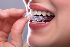 Clear Braces