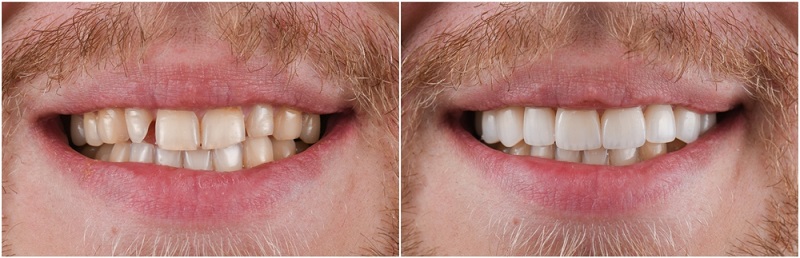 Before and after of Dental Bonding